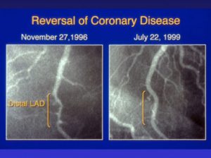 reversal of coronary disease angiogram
