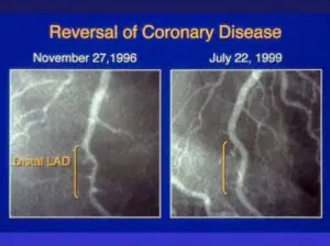 reversal of coronary disease angiogram