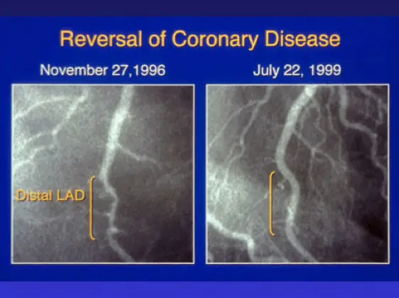 reversal of coronary disease angiogram
