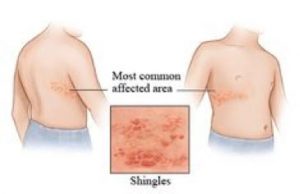 shingles shingrix injection site diagram