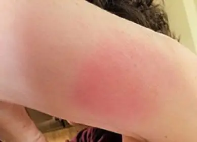 Shingrix injection site