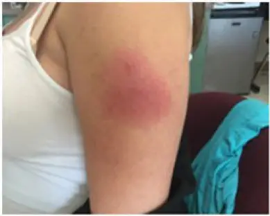 Shingrix injection site