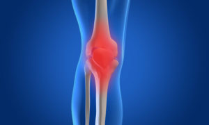 Knee Osteoarthritis curearthritis.org