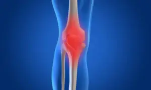 Knee Osteoarthritis curearthritis.org