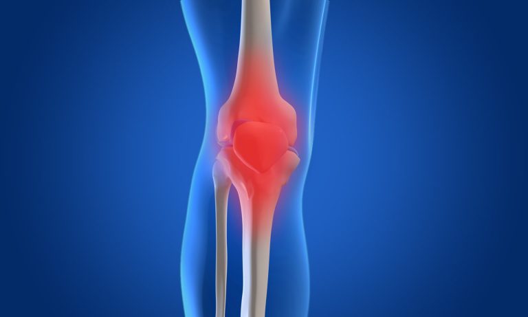 Knee Osteoarthritis curearthritis.org