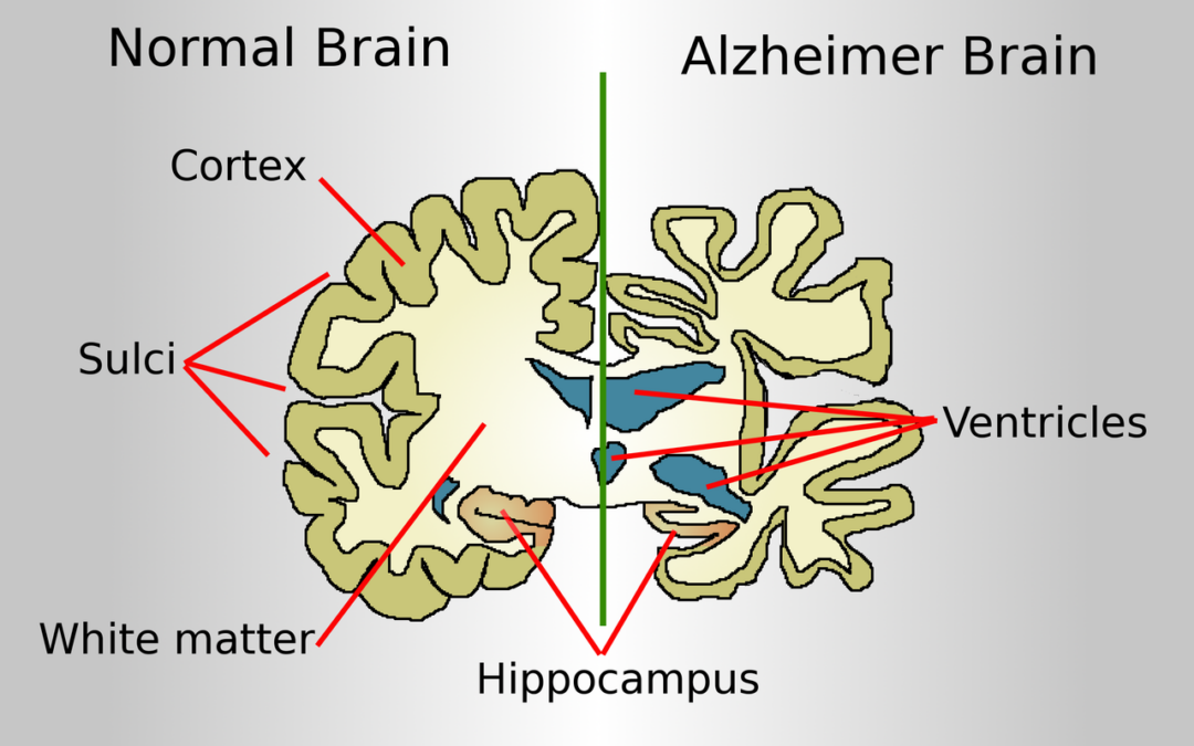 Drawing comparing how a brain of an Alzheimer disease patient is affected to a normal brain by Garrondo Wikicommons