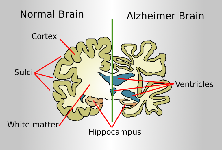 Drawing comparing how a brain of an Alzheimer disease patient is affected to a normal brain by Garrondo Wikicommons