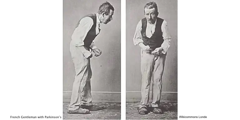 man with parkinsons Wikicommons Londe