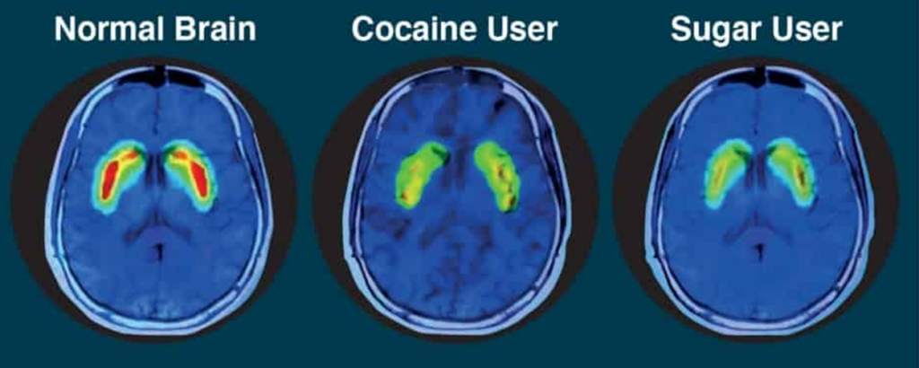 brain scans comparing drug vs sugar use