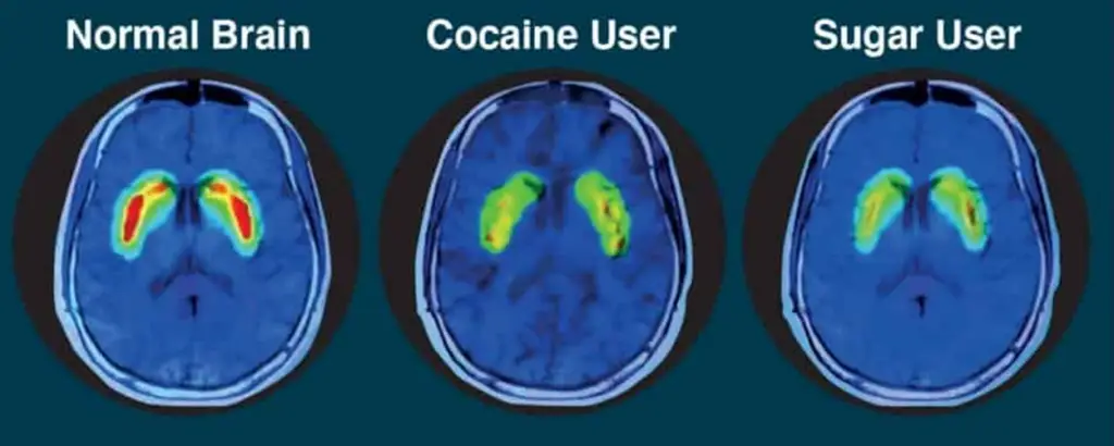 brain scans comparing drug vs sugar use